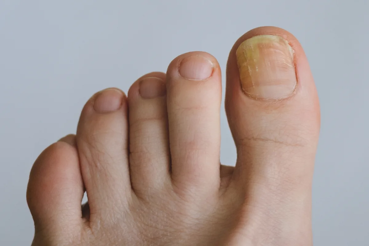 uñas amarillentas en los pies